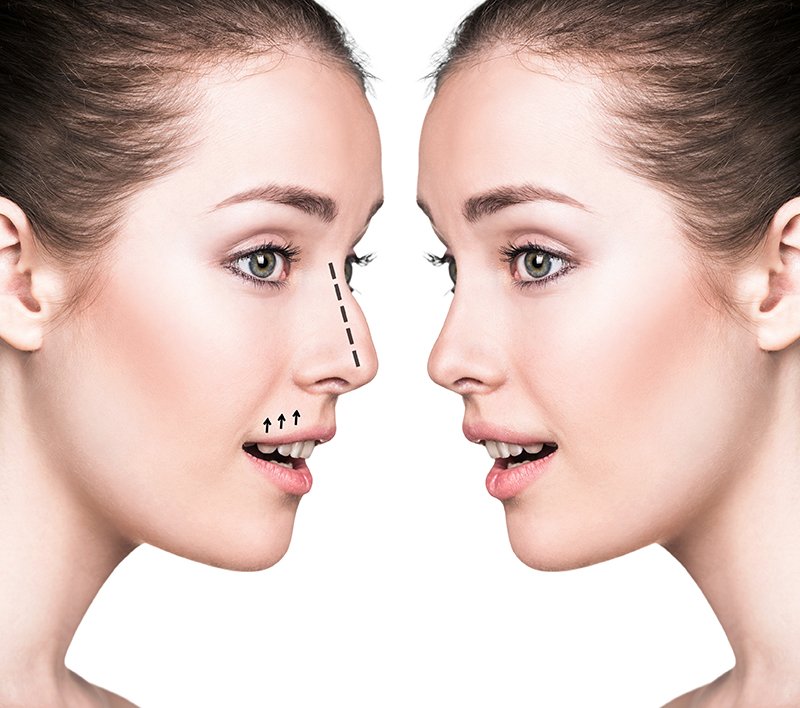 A Step-By-Step Guide to Rhinoplasty