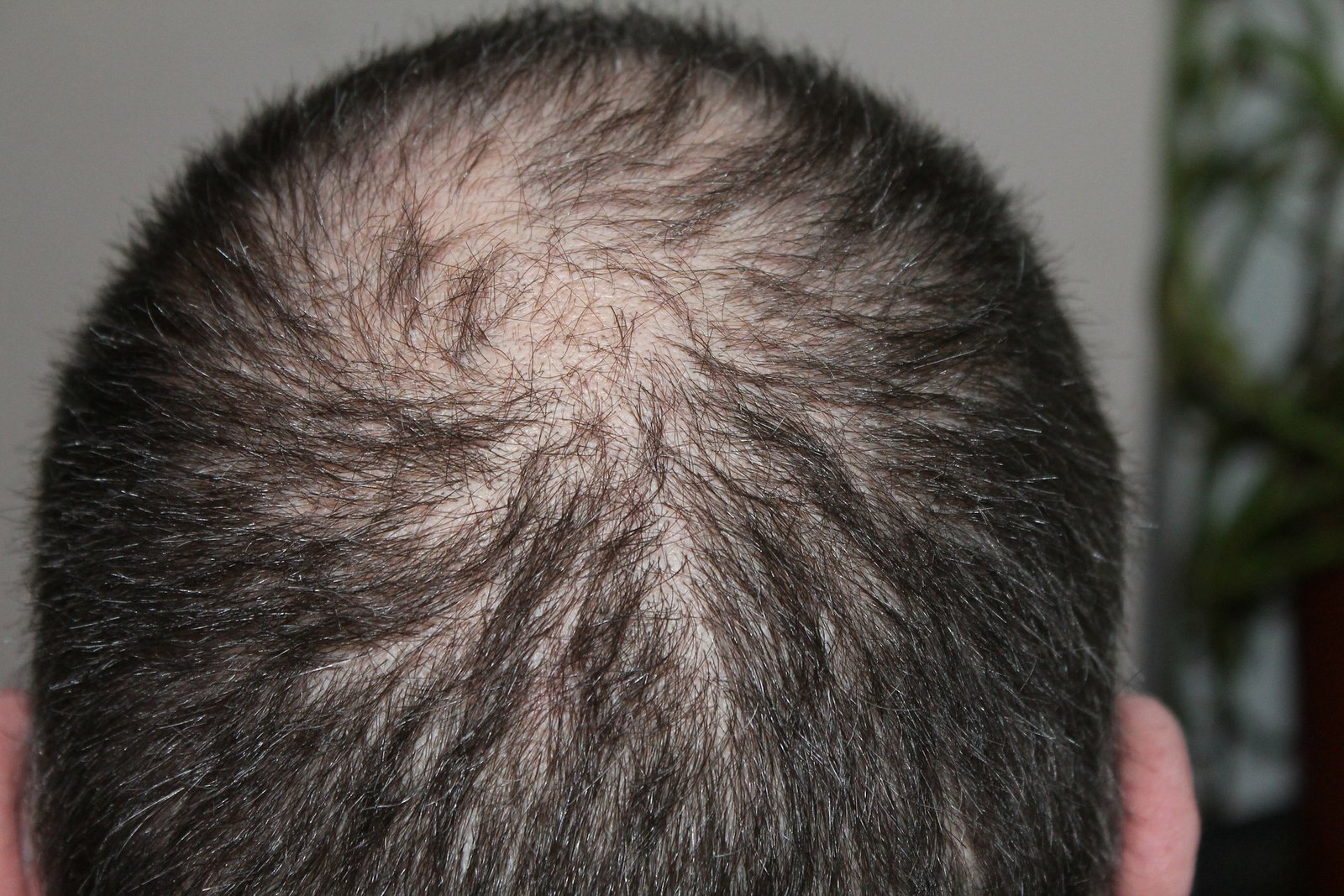 Cost Effective Solutions To Combating Hair Loss