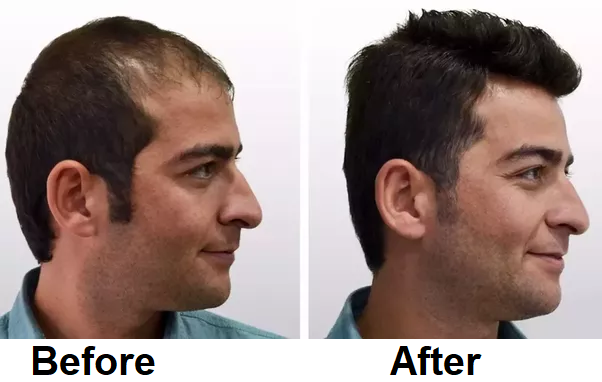 hair transplant in amritsar