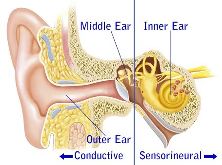 Know about Bilateral Hearing Loss