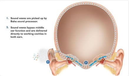 Hearing Loss in One Ear?