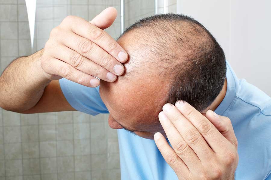 Hair Transplant