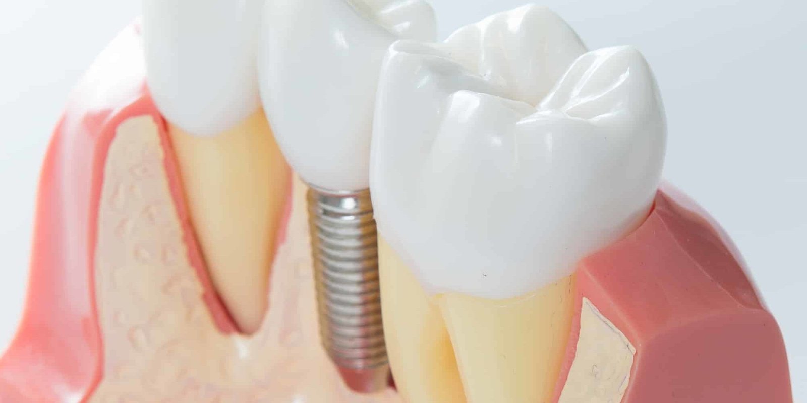 Top Factors To Consider When Getting Artificial Teeth