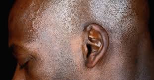 Crackling Noise in Ear